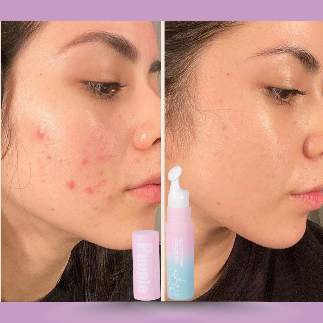 Esencia Antiacnè - Control Grasa KARITÉ